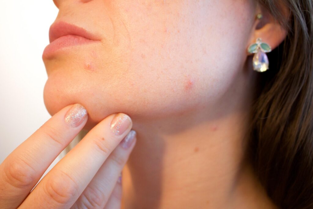 Close-up of facial acne on the chin and cheek, highlighting common acne breakouts and blemished skin.